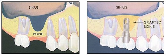 Dental implant procedure comparison showing bone grafting and implant placement in jaw.