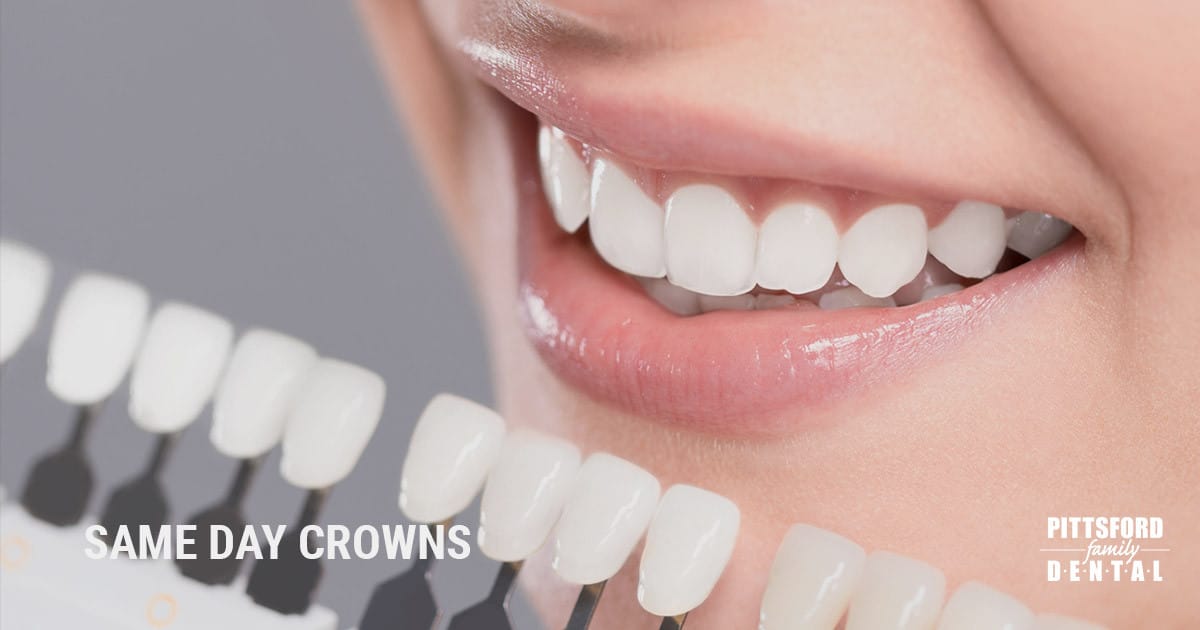 Close-up of patient's bright smile showcasing white dental crowns with Pittsford Family Dental branding.