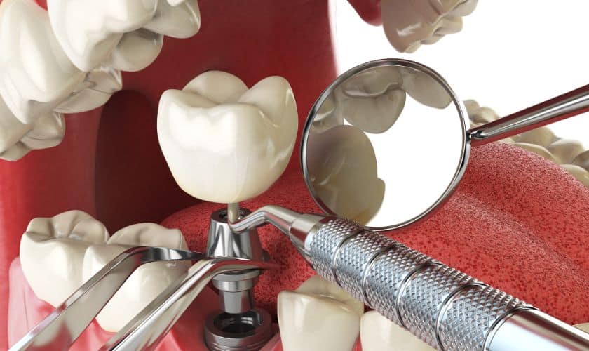 dental implants