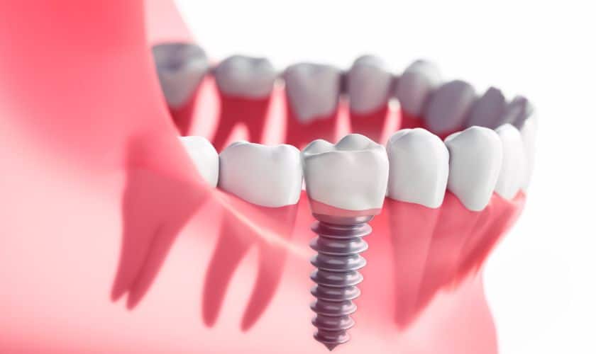 Dental Implants in Pittsford
