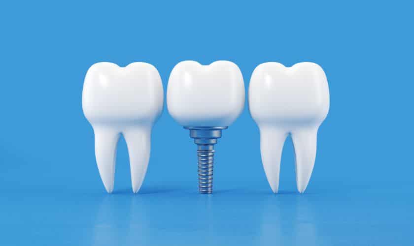 dental implants