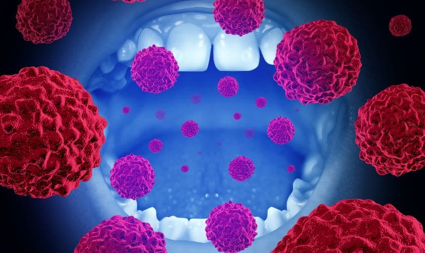 oral cancer