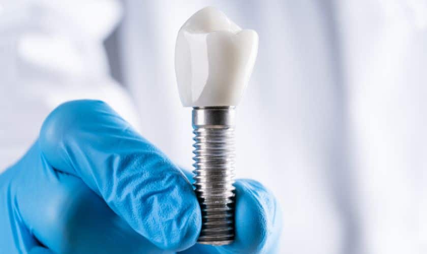 dental implant