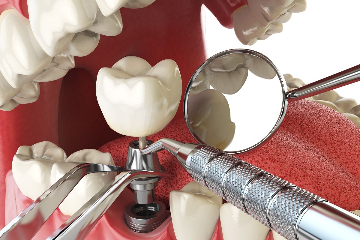 dental implants in Pittsford