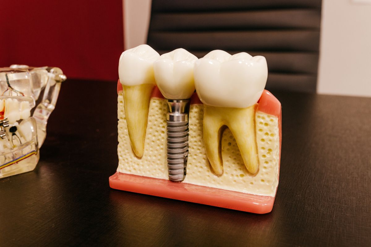 dental implant provider in Pittsford
