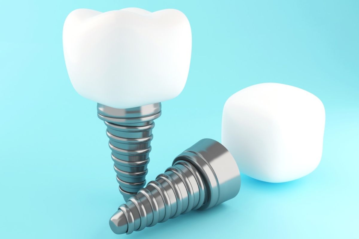 dental implants