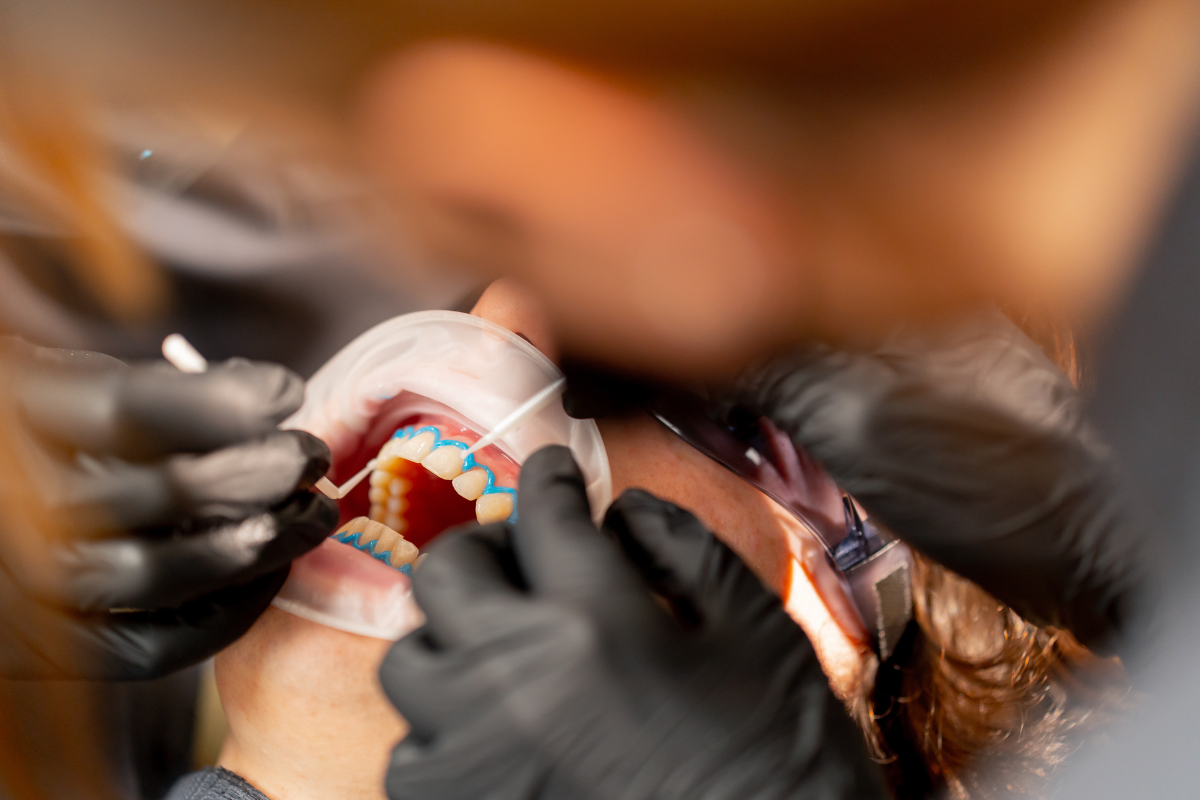 Teeth Whitening