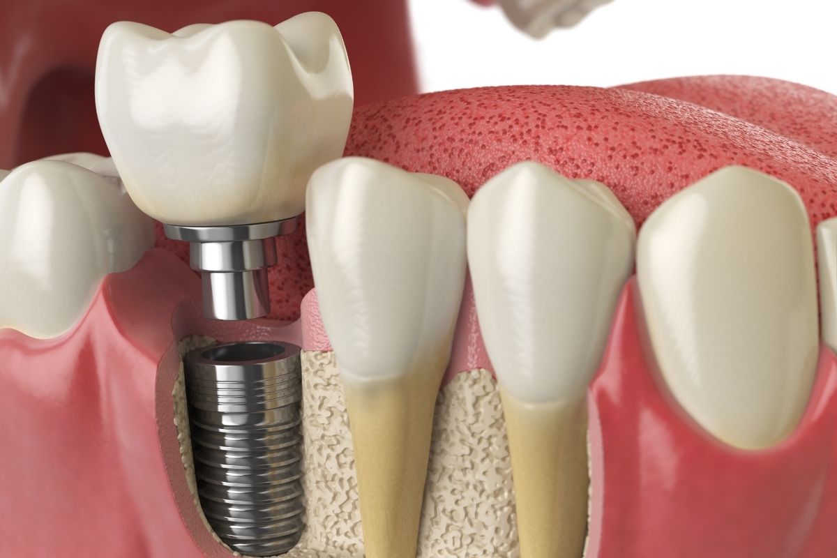 Dental Implant