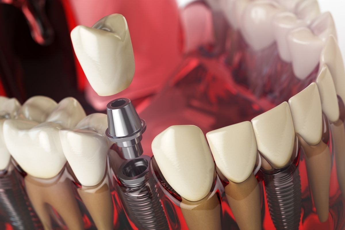 Dental Implants