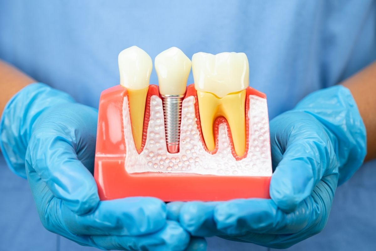 Dental Implants Safety